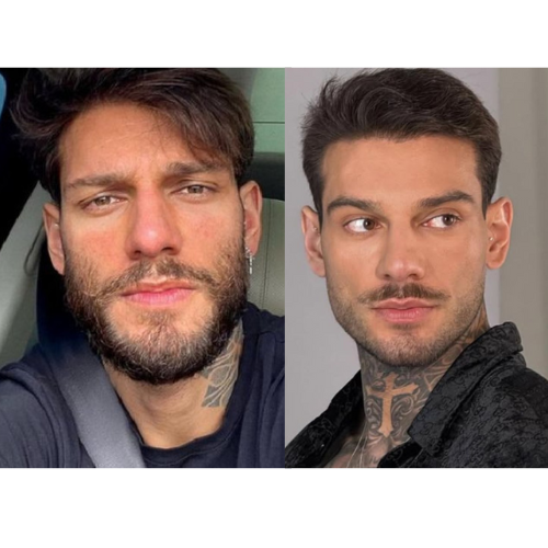 lucas luco antes x depois minoxidil 