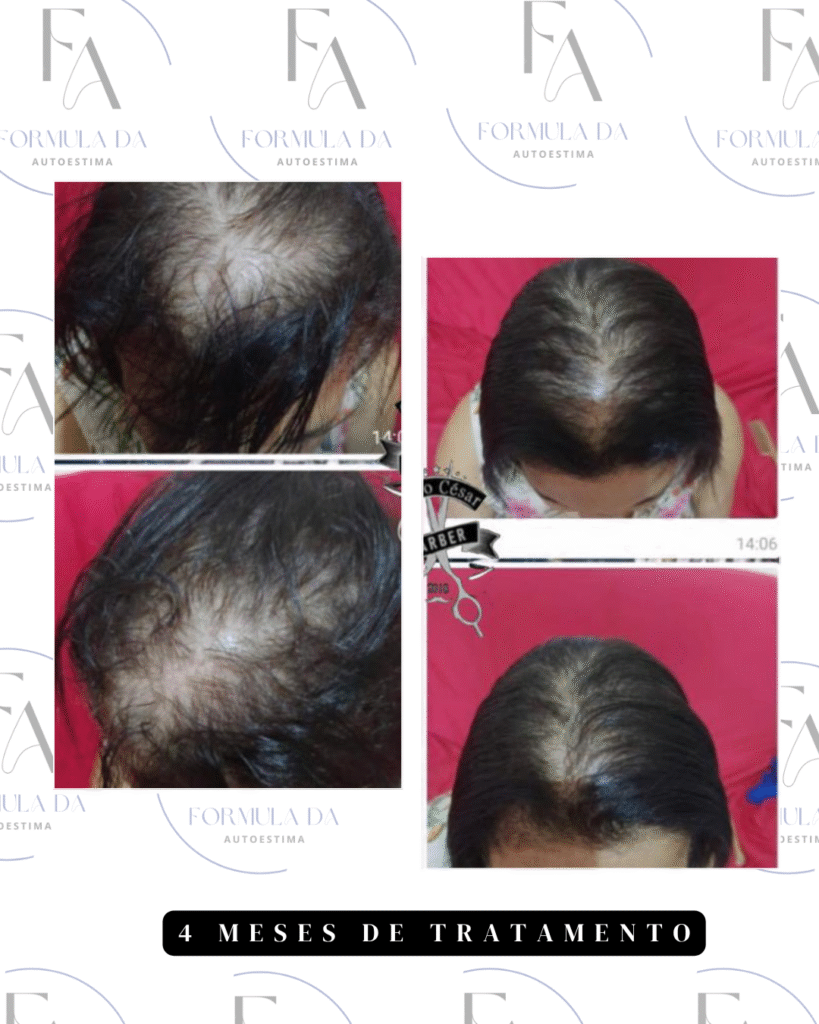 antes x depois