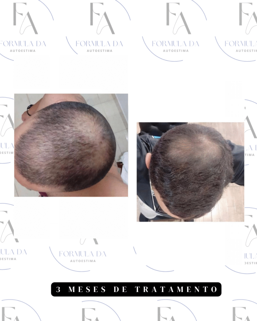 antesx depois minoxidil