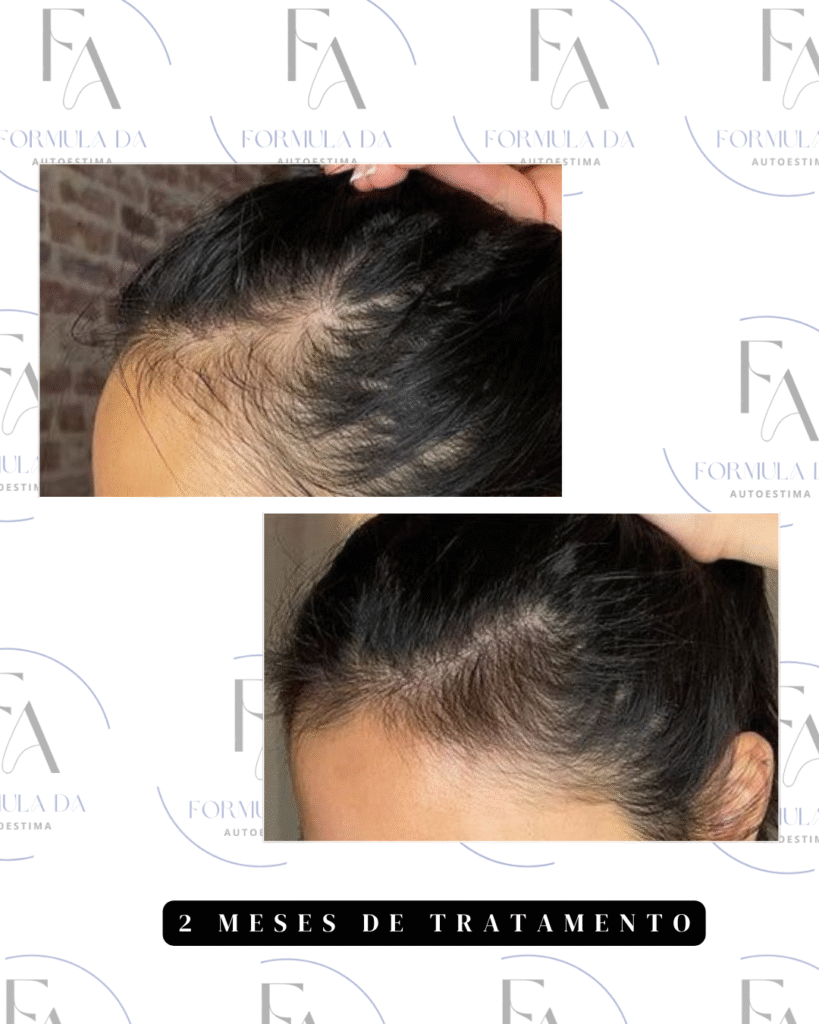 antesxdepois minoxidil.