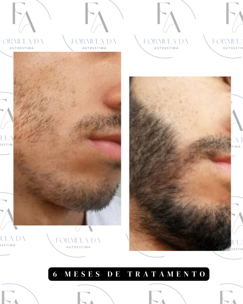 antesxdepois minoxidil