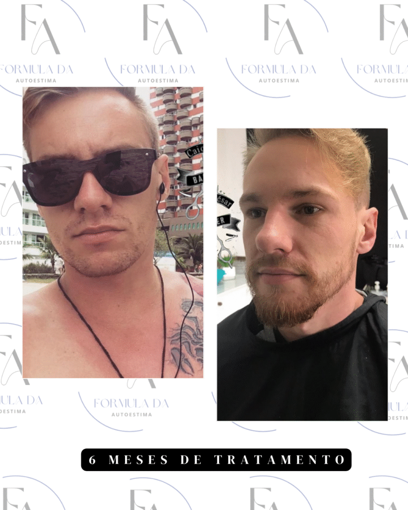antesxdepois minoxidil..