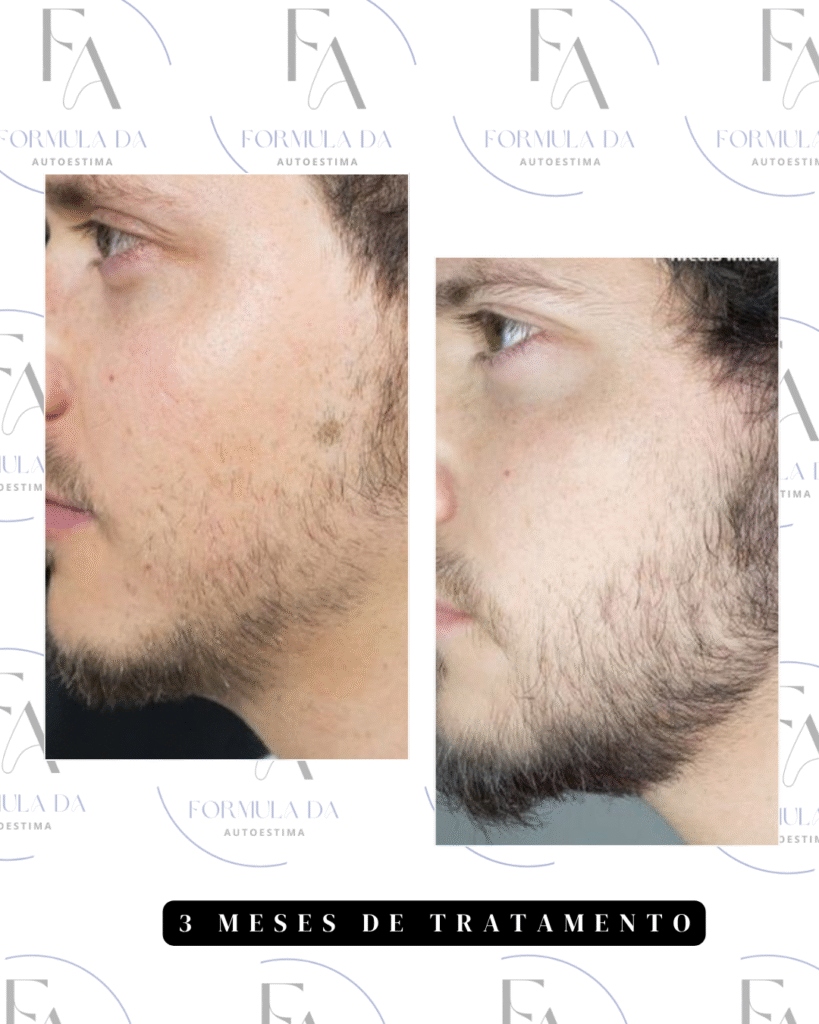 .antesxdepois minoxidil