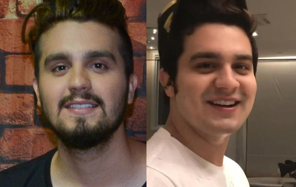 luan santana antes x depois minoxidil